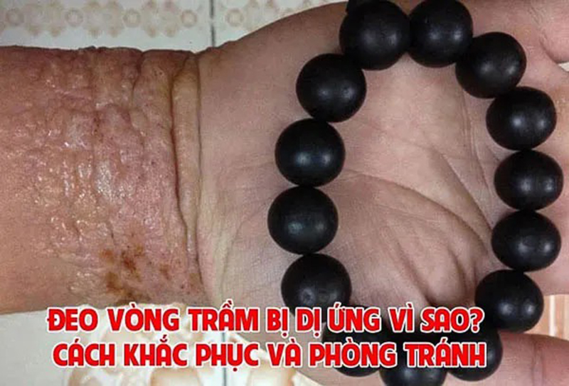 deo-vong-tram-bi-di-ung